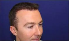 Haartransplantation - Vorher Foto - Prohaarklinik