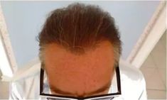 Haartransplantation - Vorher Foto - Prohaarklinik