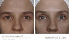 Eyelid surgery (Blepharoplasty) - Photo before - Dr n. med. Marcin Bieńkowski