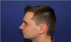Haartransplantation - Vorher Foto - Prohaarklinik