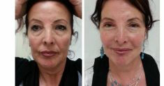Lipofilling (grasso) - Foto del prima - Dott. Luca Leva Chirurgo Plastico