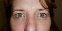 Eyelid surgery (Blepharoplasty) - Photo before - Klinika Laser Esthetic