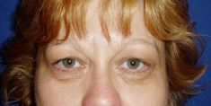 Eyelid surgery (Blepharoplasty) - Photo before - Klinika Laser Esthetic