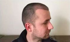 Haartransplantation - Vorher Foto - Prohaarklinik
