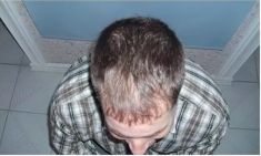 Haartransplantation - Vorher Foto - Prohaarklinik