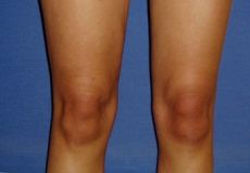 Liposuction - Photo before - Klinika Laser Esthetic