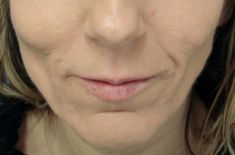 Lipofilling, Lipografting, Lipotransfer (přenos a aplikace vlastního tuku) - fotka před - MUDr. Evžen Trupar Ph.D.