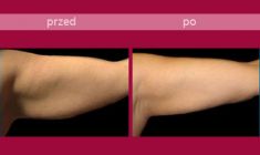Body-jet liposukcja (WAL) - Zdjęcie przed - HORIZON MEDICAL CENTER Klinika Medycyny Regeneracyjnej