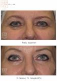 Ultherapy - Photo before - Dr n. med. Marcin Bieńkowski