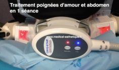 Liposuccion laser - CoolLipo - Cliché avant - Dr AMAT - ????Greffe FUE 2.0 Medic Xpert