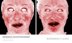 Spider veins laser removal (redness, birh marks) - Photo before - Bieńkowscy Clinic®