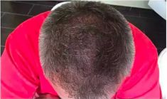 Haartransplantation - Vorher Foto - Prohaarklinik