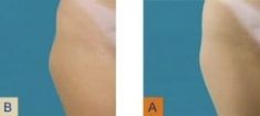 Liposuzione laser - Smart Lipo - Foto del prima - Dr. Luigi Mazzi
