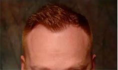 Haartransplantation - Vorher Foto - Prohaarklinik
