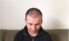 Haartransplantation - Vorher Foto - Prohaarklinik