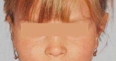 Operace uší (Otoplastika) - fotka před - OB Care