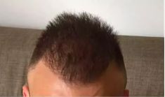 Haartransplantation - Vorher Foto - Prohaarklinik
