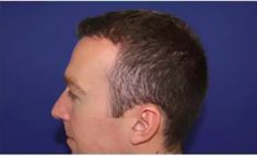 Haartransplantation - Vorher Foto - Prohaarklinik
