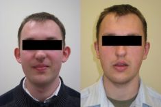 Ear surgery (Otoplasty) - Photo before - ARS ESTETICA – Klinika Medycyny Estetycznej i Laseroterapii