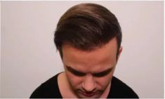 Haartransplantation - Vorher Foto - Prohaarklinik