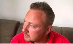 Haartransplantation - Vorher Foto - Prohaarklinik