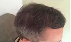 Haartransplantation - Vorher Foto - Prohaarklinik