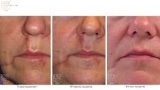 Laser Scar Treatment - Photo before - Dr n. med. Marcin Bieńkowski