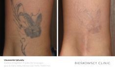 Laserowe usuwanie tatuażu i pigmentów - Zdjęcie przed - Dr Ilona Wnuk-Bieńkowska