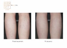 Spider veins laser removal (redness, birh marks) - Photo before - Bieńkowscy Clinic®
