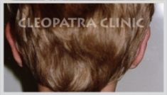 Ear surgery (Otoplasty) - Photo before - Cleopatra Clinic, Klinika Plastické Chirurgie s.r.o.