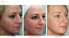 Laser Scar Treatment - Photo before - Dr n. med. Marcin Bieńkowski