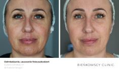 Spider veins laser removal (redness, birh marks) - Photo before - Bieńkowscy Clinic®