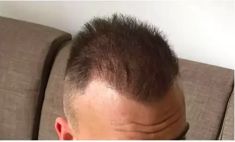 Haartransplantation - Vorher Foto - Prohaarklinik