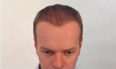 Haartransplantation - Vorher Foto - Prohaarklinik