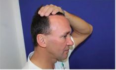 Haartransplantation - Vorher Foto - Prohaarklinik