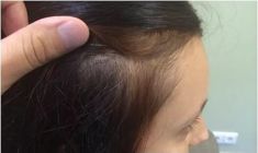 Haartransplantation - Vorher Foto - Prohaarklinik