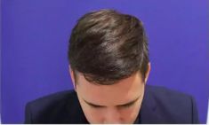 Haartransplantation - Vorher Foto - Prohaarklinik