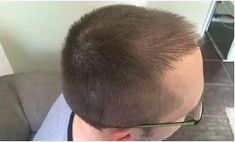 Haartransplantation - Vorher Foto - Prohaarklinik