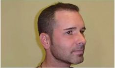 Haartransplantation - Vorher Foto - Prohaarklinik