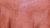Radiofrequency Rejuvenation (Aluma, accent, TriPollar, Spa RF device, Re-Age) - Photo before - Klinika Laser Esthetic