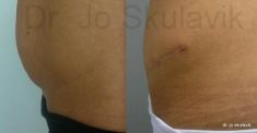 Abdominoplasty (Tummy Tucks) - Photo before - Dr. med. Jozefina Skulavik