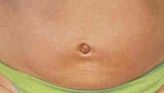 Radiofrequency Rejuvenation (Aluma, accent, TriPollar, Spa RF device, Re-Age) - Photo before - Klinika Laser Esthetic