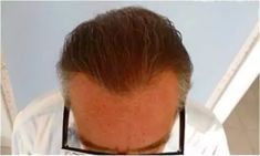 Haartransplantation - Vorher Foto - Prohaarklinik
