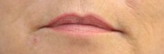 Dermal fillers - Photo before - MUDr. Jiřina Šilhánková