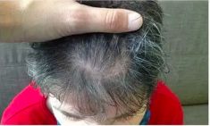 Haartransplantation - Vorher Foto - Prohaarklinik