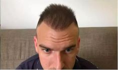 Haartransplantation - Vorher Foto - Prohaarklinik