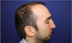 Haartransplantation - Vorher Foto - Prohaarklinik