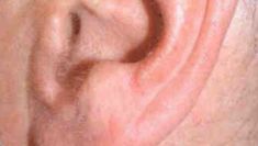 Laser hair removal - Photo before - Klinika Laser Esthetic