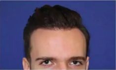 Haartransplantation - Vorher Foto - Prohaarklinik