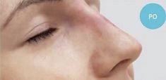Radiesse (Calcium hydroxylapatit) - Fotka pred - Chirkoz Medical Clinic